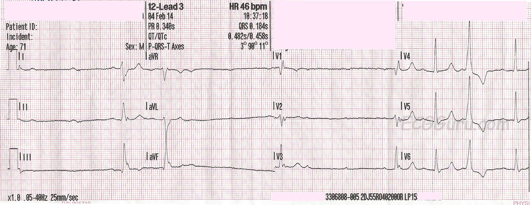 high-grade-av-block-ecg-guru-instructor-resources